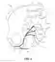 Fig. 04 - Implantable electrical stimulator with deflecting tip lead