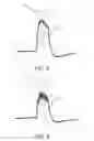 Fig. 05 - Apparatus, system, and method for neurostimulation by high frequency ultrasound