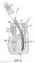 Fig. 04 - ENDODONTIC INSTRUMENTS AND METHODS OF MANUFACTURING THEREOF