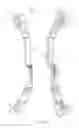 Fig. 13 - Hybrid riser for archery bow