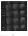 Fig. 08 - Noise suppression for wave-CAIPI