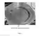 Fig. 12 - Interchangeable Edge Rings For Stabilizing Wafer Placement And System Using Same