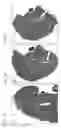 Fig. 02 - AIRWAY MUCUS IMPACTION