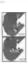 Fig. 08 - AIRWAY MUCUS IMPACTION