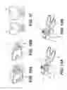 Fig. 06 - Surgical tensor where each distraction mechanism is supported and aligned by at least two guide shafts