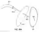 Fig. 40 - Systems and methods for mesh delivery and prevention of port-site hernia