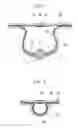 Fig. 07 - Procedure for endoscopic full-thickness resection