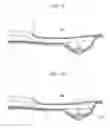 Fig. 08 - Procedure for endoscopic full-thickness resection