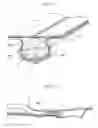 Fig. 09 - Procedure for endoscopic full-thickness resection