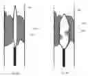 Fig. 08 - Apparatus and method for vessel occlusion removal