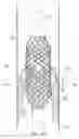 Fig. 09 - Apparatus and method for vessel occlusion removal