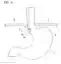 Fig. 07 - Method for treating reflux esophagitis