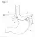 Fig. 08 - Method for treating reflux esophagitis