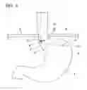 Fig. 09 - Method for treating reflux esophagitis