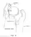 Fig. 09 - Method and apparatus for accessing the interior of a hip joint, including the provision and use of a novel telescoping access cannula and a novel telescoping obturator