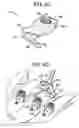 Fig. 13 - Multipoint fixation implants and related methods