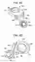 Fig. 16 - Multipoint fixation implants and related methods