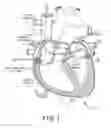 Fig. 02 - Spray nozzle design for a catheter