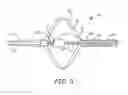 Fig. 04 - Spray nozzle design for a catheter