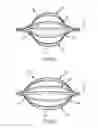 Fig. 09 - Bendable catheter arms having varied flexibility