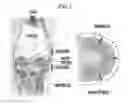 Fig. 02 - Device for supporting hoop stress of meniscus