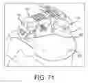 Fig. 33 - Expandable implant assembly