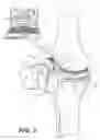 Fig. 03 - Surgical apparatus to support installation of a prosthetic component and method therefore