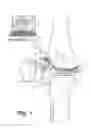 Fig. 02 - Tilting surgical tensor to support at least one bone cut