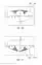 Fig. 33 - Methods and systems to provide excluded defined zones for increasing accommodative amplitude