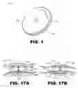 Fig. 02 - Implantable electroacupuncture system and method for treating depression and similar mental conditions