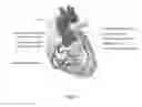 Fig. 02 - One-stop Surgical Method of Coronary Intervention Therapy Combined with Endovascular Aortic Repair