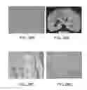 Fig. 22 - Saposin C pharmaceutical compositions and methods of treating cancer