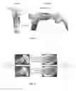Fig. 04 - Tracheal tube apparatus and methods