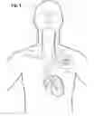 Fig. 02 - Implantable device for providing electrical stimulation of cervical vagus nerves for treatment of chronic cardiac dysfunction