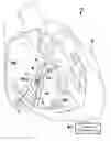 Fig. 01 - AV synchronous VfA cardiac therapy
