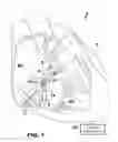 Fig. 02 - AV synchronous VfA cardiac therapy
