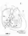 Fig. 02 - VFA cardiac resynchronization therapy