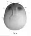 Fig. 06 - IMPLANTABLE PROSTHESES FOR REDUCING VISIBILITY OF BULGING FROM IMPLANTED MEDICAL DEVICES