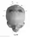 Fig. 07 - IMPLANTABLE PROSTHESES FOR REDUCING VISIBILITY OF BULGING FROM IMPLANTED MEDICAL DEVICES