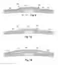 Fig. 08 - IMPLANTABLE PROSTHESES FOR REDUCING VISIBILITY OF BULGING FROM IMPLANTED MEDICAL DEVICES
