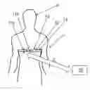 Fig. 01 - ANTENNA COUPLING OF IMPLANTABLE DEVICES OR DEVICES ATTACHED TO A PERSON AND AN EXTERNAL DEVICE BY ORIENTATION DEPENDENT SWITCHING OF ANTENNAS