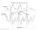 Fig. 06 - Detection of atrial fibrillation