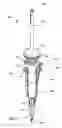 Fig. 11 - Lateral access retractor and core insertion