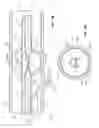 Fig. 04 - Microcatheter occlusion embolization catheter
