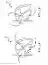 Fig. 02 - Device for securing heart valve leaflets