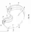 Fig. 07 - Modular, plastic knee replacement with locking mechanism