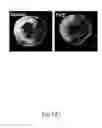 Fig. 07 - METHOD AND KIT FOR MYOCARDIAL REPERFUSION, AND METHOD FOR ATTENUATING OR REDUCING MYOCARDIAL REPERFUSION INJURY