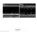 Fig. 44 - METHOD AND KIT FOR MYOCARDIAL REPERFUSION, AND METHOD FOR ATTENUATING OR REDUCING MYOCARDIAL REPERFUSION INJURY