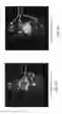 Fig. 15 - Bone marrow-, reticuloendothelial system-, and/or lymph node-targeted radiolabeled liposomes and methods of their diagnostic and therapeutic use