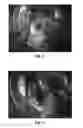 Fig. 02 - Method of implantation of left ventricular mechanical assist device HeartMate III
